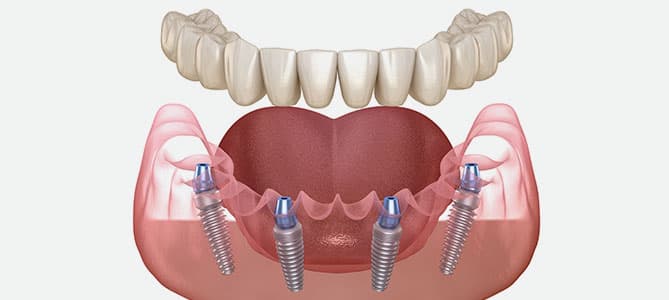 3D illustration of All-on-4 dental implant system showing four implants supporting a full arch prosthesis