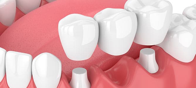 3D rendering of a dental crown and bridge restoration