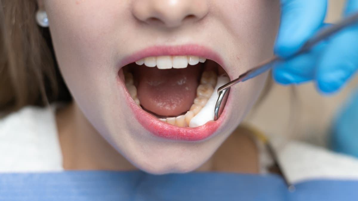 Dental Fillings: Types, Cost, and What to Expect