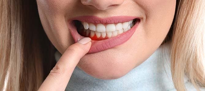 Close-up of inflamed gumline showing signs of gum disease