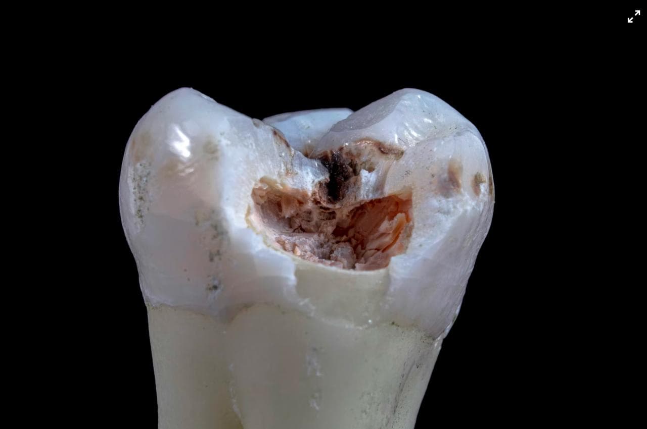 Close-up of an extracted tooth showing severe decay and cavity damage on the crown