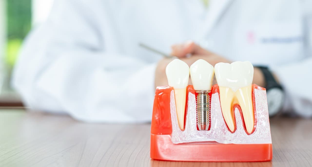 Close-up of dental implant model showing titanium post anchored in jawbone with prosthetic crown attached