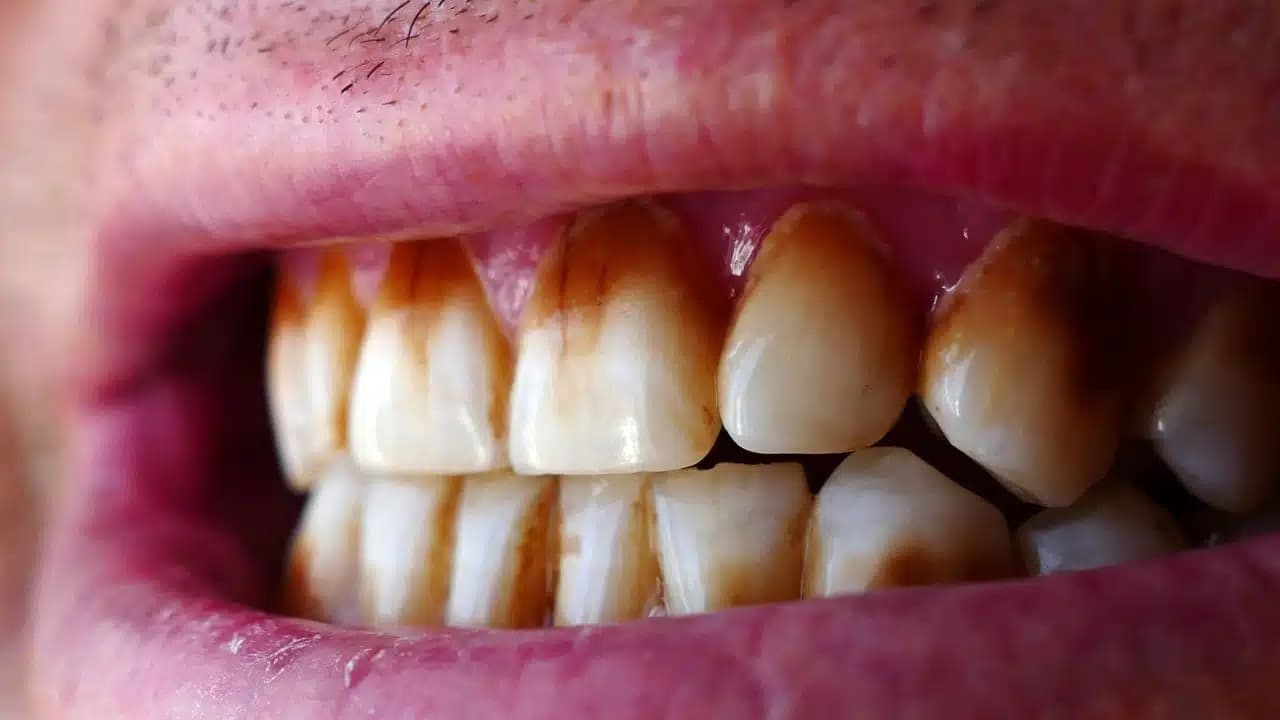 Close-up of teeth with heavy brown and yellow nicotine and tar staining between and on tooth surfaces