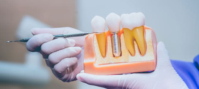 Gloved hands holding jaw model with dental implant cross-section, dental probe pointing at it
