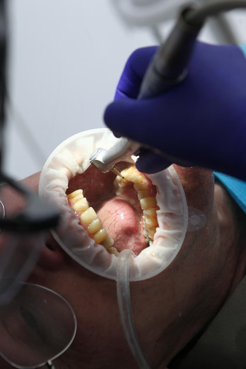 Close-up of ultrasonic dental scaling removing tartar from teeth