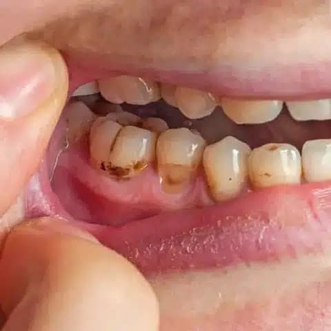 Close-up of teeth showing tartar buildup along the gumline