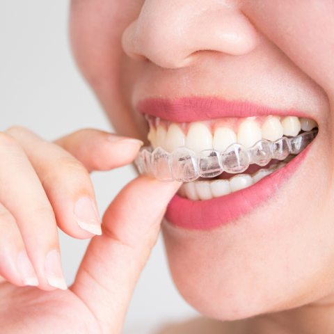 How Much Does Invisalign Cost Without Insurance?
