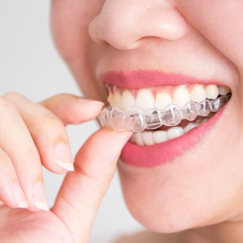 How Much Does Invisalign Cost Without Insurance in California?