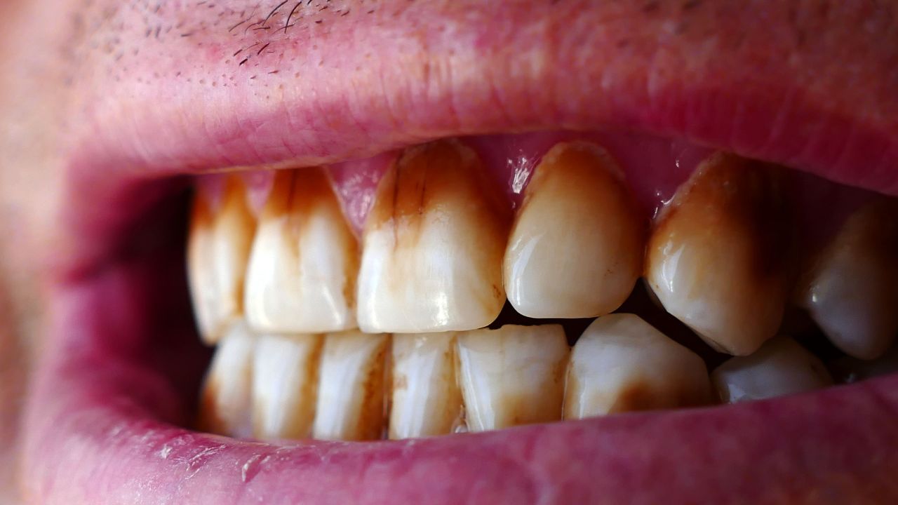 Cigarette and tobacco stains on teeth