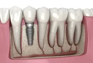 Dental Implant Image