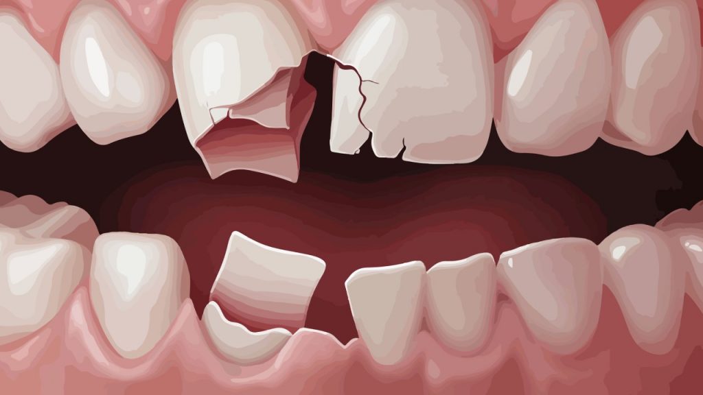 Types of Cracked Teeth