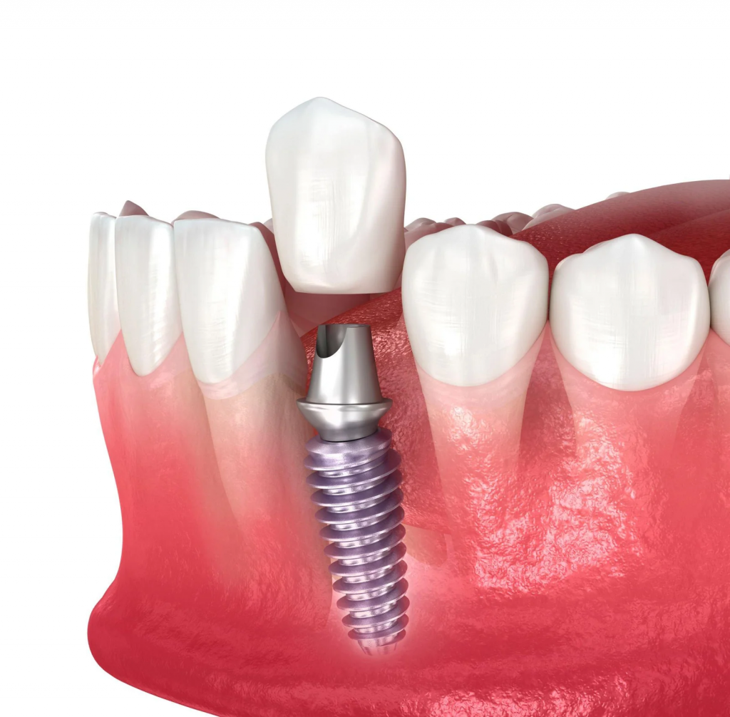 Dental Implant Image