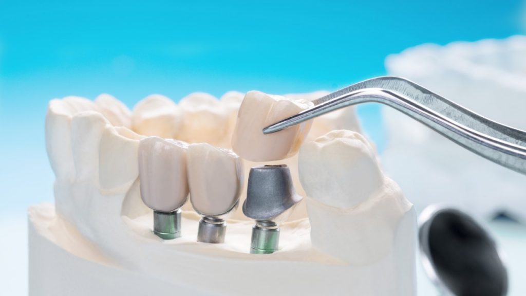 Differences Between Veneers and Crowns