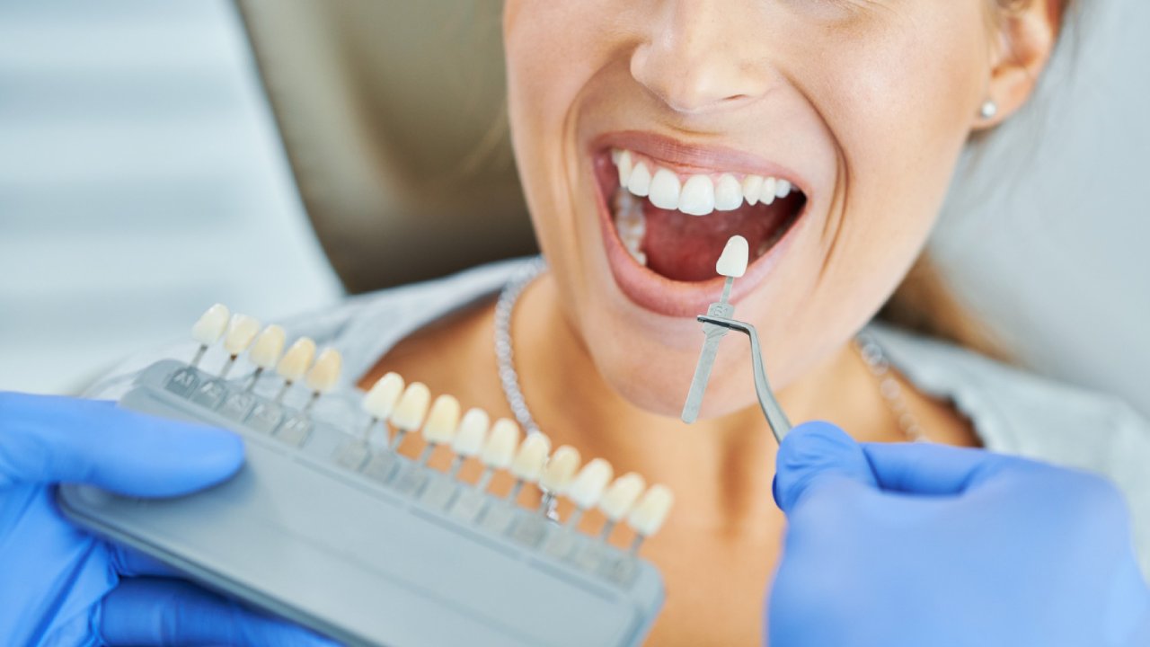 Veneers vs. Crowns