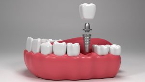 How Long Do Tooth Implants Last