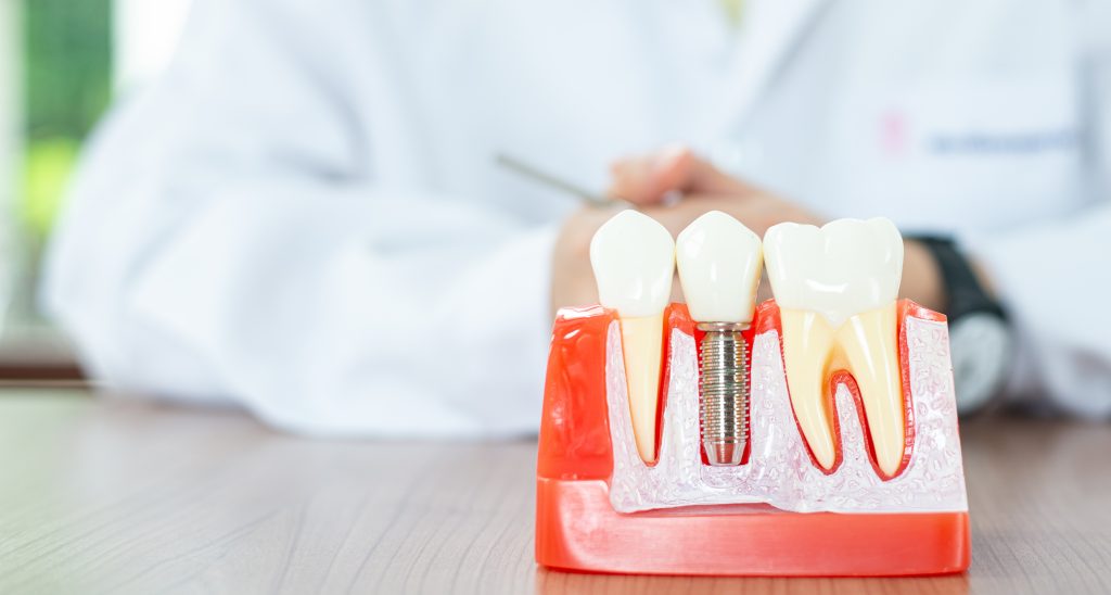 The All-on-4 Procedure