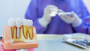 Understanding All-on-4 Dental Implants