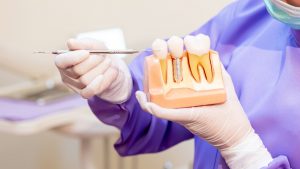 dental implants process